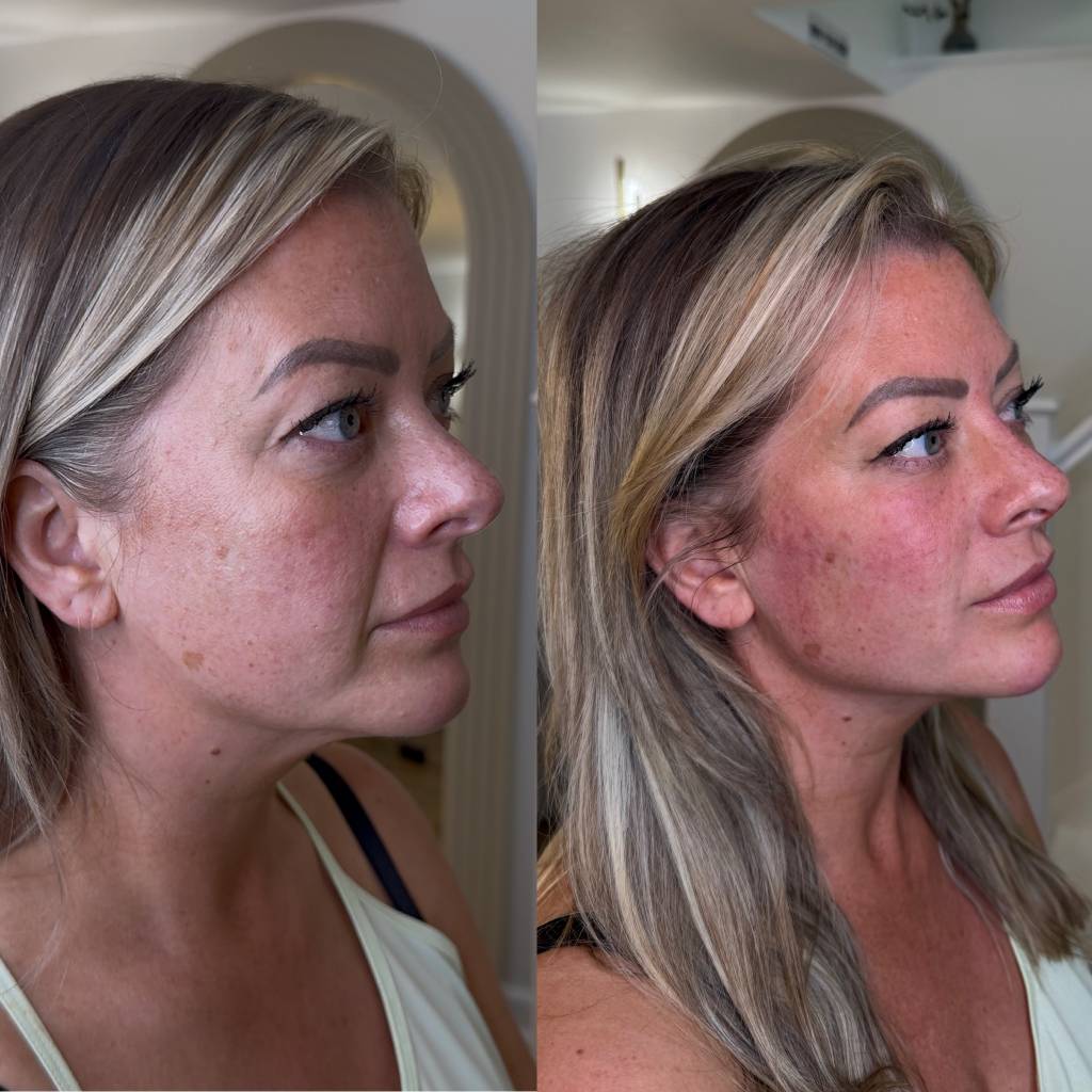 Treatment detmsl filler